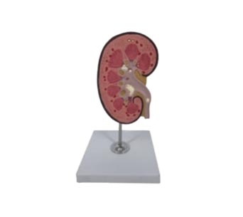 肾脏和肾结石解剖模型